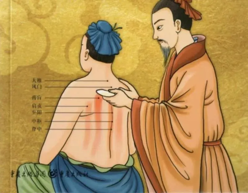 Klassieke afbeelding van een Guasha-behandeling uit de Traditionele Chinese Geneeskunde