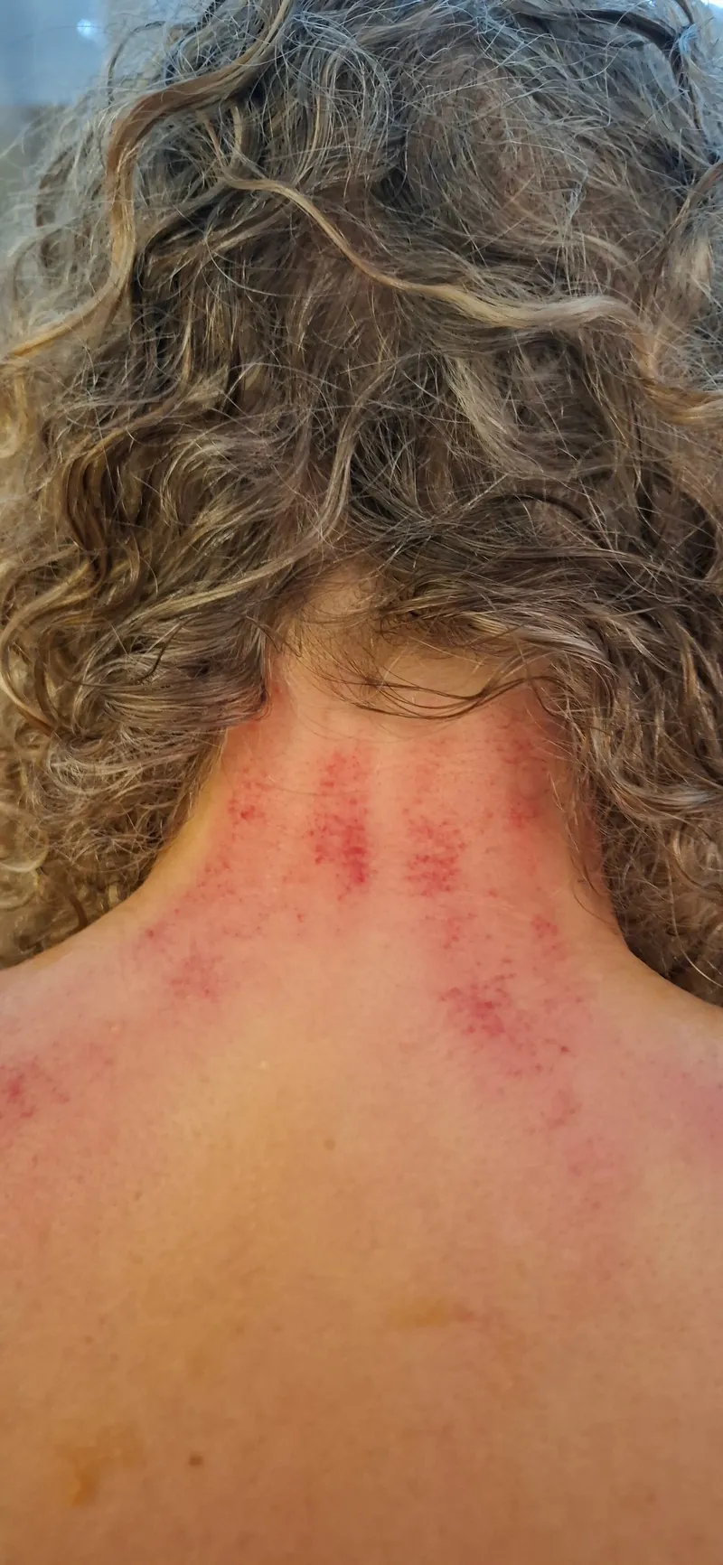 Sha-verkleuringen in de nek na een Guasha-behandeling